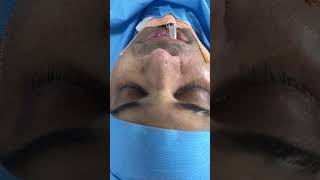 Radix and alar base reduction nose contouring surgery [upl. by Lefty]