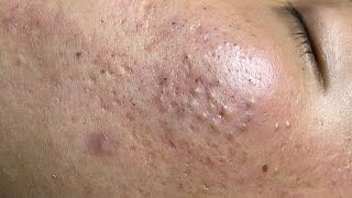 ACNE TREATMENT VU QUYNH MI  Blackheads On Boy Face 2024FULL [upl. by Nancey]