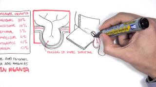 Introduction to Direct and Indirect Inguinal Hernia [upl. by Vasilis]