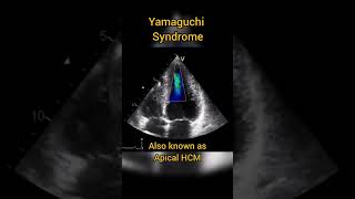 Apical Hypertrophic Cardiomyopathy HCM or Yamaguchi syndrome echocardiography [upl. by Athalee]