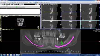 Implant PLanning with Acteon Imaging Suite CBCT Cone Beam part 2 [upl. by Max511]