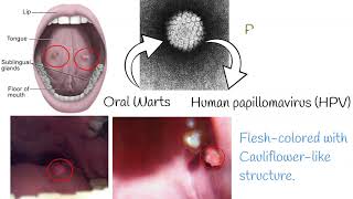 Oral Papilloma  Symptoms causes treatment [upl. by Giamo746]