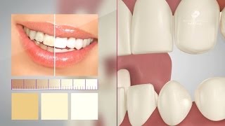 Fogfehérítés videó  MindentMent® Fogászat [upl. by Neelra]