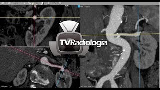 REFORMATAÇÃO EM TOMOGRAFIA ANGIOTOMOGRAFIA DE ARTÉRIAS RENAIS [upl. by Russom]