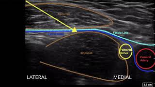 Ultrasound guided femoral nerve and fascia iliaca block [upl. by Hanala]