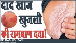 दाद खाज खुजली की रामबाण दवा  Skin Disease  Dr Mdhusudan [upl. by Meyer]