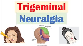 Trigeminal Neuralgia “Severe Facial Pain” Causes Pathophysiology Symptoms Diagnosis Treatment [upl. by Eileen839]