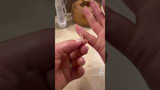 Finger peeling with palmoplantar keratoderma hand callus EPPK  Apr 8 2023 [upl. by Arlin777]