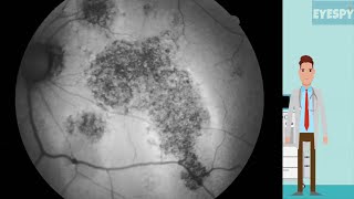 Features of Chronic CSCR on Multimodal Imaging [upl. by Mandal2]