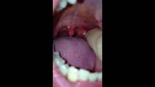 Me And My Tonsil Stones Episode 2 The Return [upl. by Gothar]