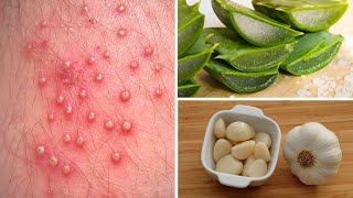 7 Powerful Home Remedies to Get Rid of Folliculitis [upl. by Pia]