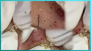 Big Cystic Acne Blackheads Extraction Blackheads amp Milia Whiteheads Removal Pimple Popping [upl. by Sefton]