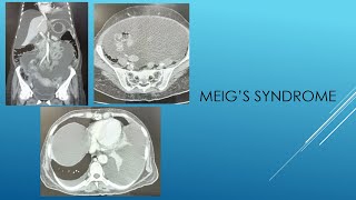 MEIGS SYNDROME [upl. by Kyle]