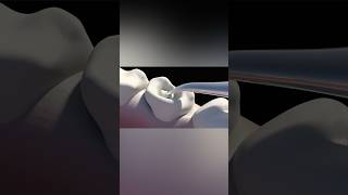 Caries Removal dentist medicalanimation [upl. by Ernestine]