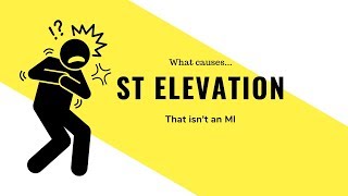 Things that mimic a STEMI on the EKG how to differentiate them [upl. by Ahsekan]