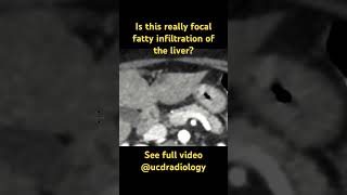 Focal fatty infiltration anatomy doctor medicalstudent radiologyresident radiology radres [upl. by Hepsoj]