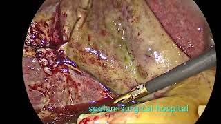 Laparoscopic Cholecystectomy For Acute Gangrenous Cholecystitis [upl. by Voorhis54]