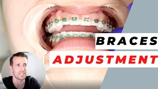 Orthodontist Explains Monthly Adjustments  Monthly Visits [upl. by Eesak]