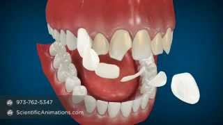 Cosmetic Dentistry Procedures  Dental Animation [upl. by Jd]