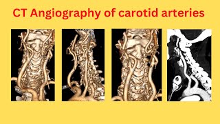 CT Angiography of carotid arteries [upl. by Hollenbeck273]