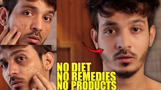 I Destroy My All Skin Problems Without any Products Home Remedies or Diet [upl. by Arretak]