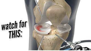 Meniscus Repair vs Meniscectomy [upl. by Jennee]