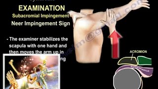 Shoulder Impingement Syndrome  Everything You Need To Know  Dr Nabil Ebraheim [upl. by Valeria161]