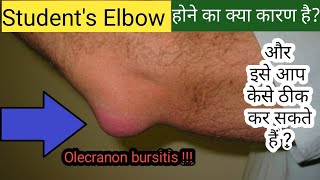 Olecranon Bursitis Elbow Bursitis  Students Elbow  Prevention Treatment Exercises amp Home Care [upl. by Eldnik579]