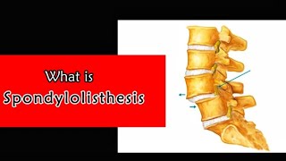 What is Spondylolisthesis [upl. by Comptom285]