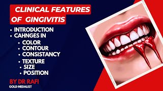 Clinical Features Of Gingivitis  Periodontology Lecture [upl. by Rihaz]