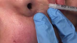 Injecting hypertrophic scars [upl. by Azne]