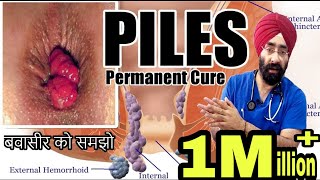 बवासीर  Piles  Hemorrhoids  समझो कारन से इलाज तक । १०० विज्ञान  हिंदी में ENG SUBTITLES [upl. by Anitsrik740]