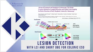 Lesion detection with LCI and Short DBE for colonic ESD with Professor Hironori Yamamoto [upl. by Parfitt]