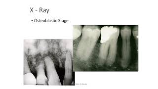 Bone Diseases 2 [upl. by Alexio]