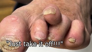 ❗️EXTREME❗️ HAMMER TOE TREATMENT [upl. by Proudlove475]