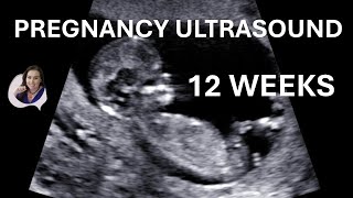 12 weeks pregnancy ultrasound video [upl. by Nnairet]