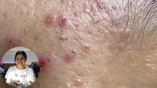 Acne Treatment Huong Da Nang The video has been lost for a long time Remove Blackheads [upl. by Leisha]