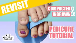 Revisiting the Deep Compacted Ingrown Toenail [upl. by Glori]