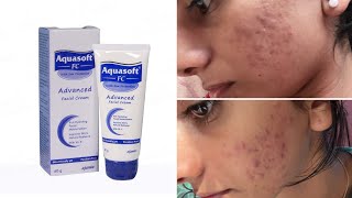 Aquasoft fc Advanced facial cream Review Malayalam  Indian pharmacy product for acne prone skin [upl. by Vachill]