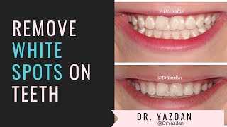 How To Remove White Spots On Teeth  Icon Dental Treatment  Dr Yazdan [upl. by Essej]