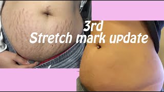 my 3rd stretch mark treatment update E2 sublative laser [upl. by Aniahs784]