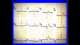 ECG normal et pathologique [upl. by Raffaello]