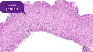 Collagenous gastritis in 90 seconds  Histology [upl. by Latton]