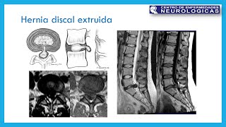 Hernia de disco intervertebral II [upl. by Nirag]