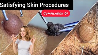 Care to skin and Relax to mind Satisfying skin tag removal compilation 01 DrAMAZINGSKIN [upl. by Alyahs]