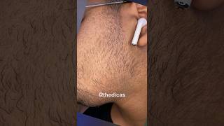 1 ANO E 6 MESES usando MINOXIDIL evolução minoxidil minoxidil barba thedicas [upl. by Soutor]