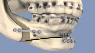 BSSO amp Osseous Genioplasty [upl. by God]