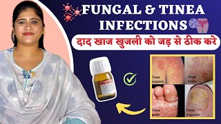 Homeopathic Medicine For Fungal amp Tinea Infections  Fungal Infection Treatment  Dr Arwa Bohra [upl. by Fortier]