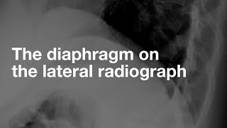 The Diaphragm on the Lateral CXR [upl. by Ssilem]