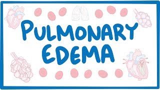 Pulmonary Edema  causes symptoms diagnosis treatment pathology [upl. by Atinrev903]